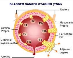 bladder cancer symptoms